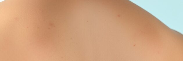 Trądzik na plecach: dla kogo jest, jak go używać i jakich efektów oczekiwać